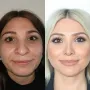 Turska klinika hvali se na Instagramu nevjerojatnim transformacijama pacijenata