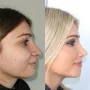 Turska klinika hvali se na Instagramu nevjerojatnim transformacijama pacijenata