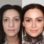 Turska klinika hvali se na Instagramu nevjerojatnim transformacijama pacijenata
