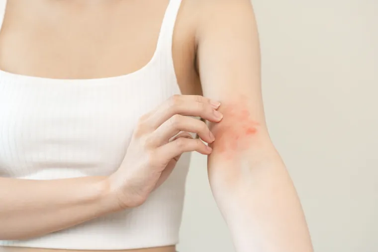 Uz to, nerijetko dolazi do razvoja ekcema, odnosno atopijskog dermatitisa koji je karakterističan po svrbežu i osipu. 