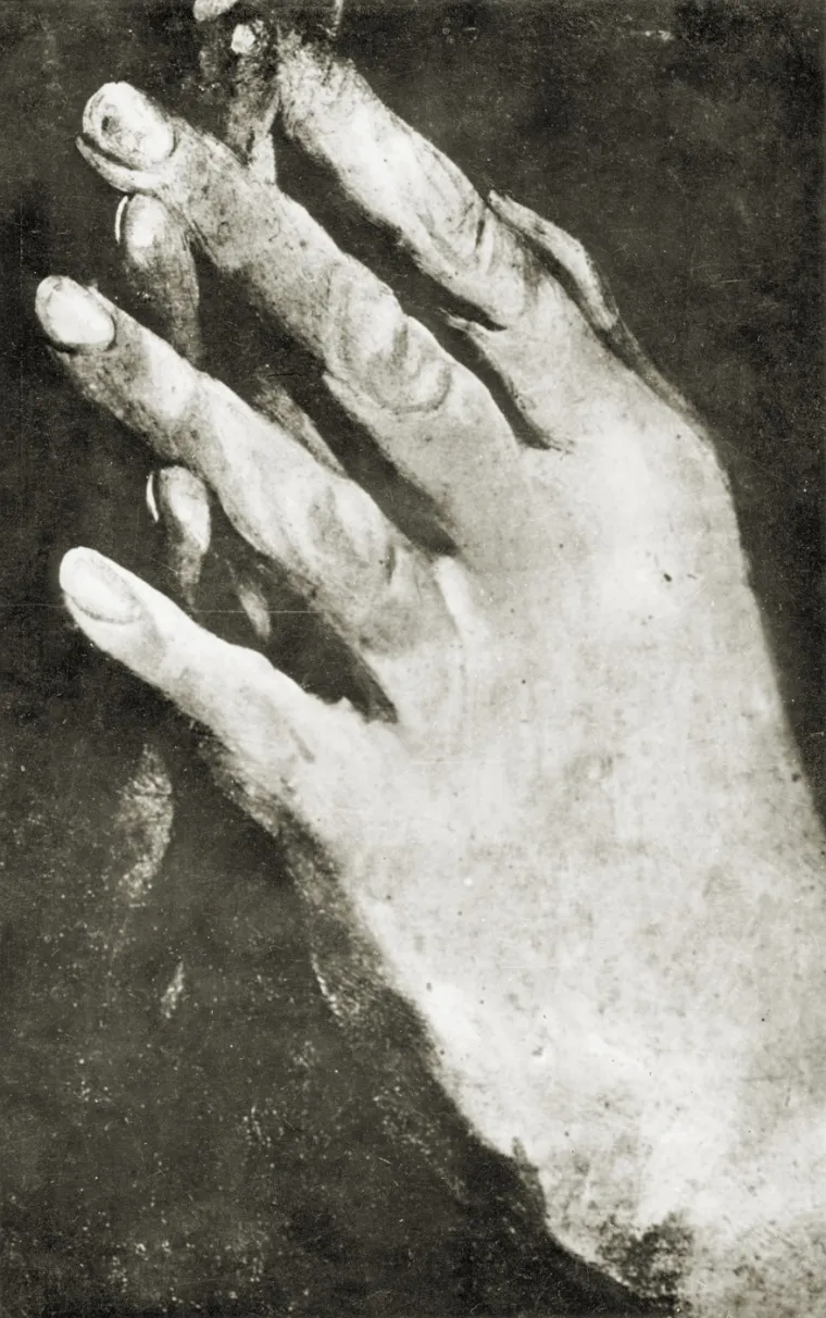 Patnja od kroničnih zdravstvenih problema, uključujući bolesti jetre, pridonijela je njegovoj smrti. Ovo je fotografija Beethovenovih prstiju.