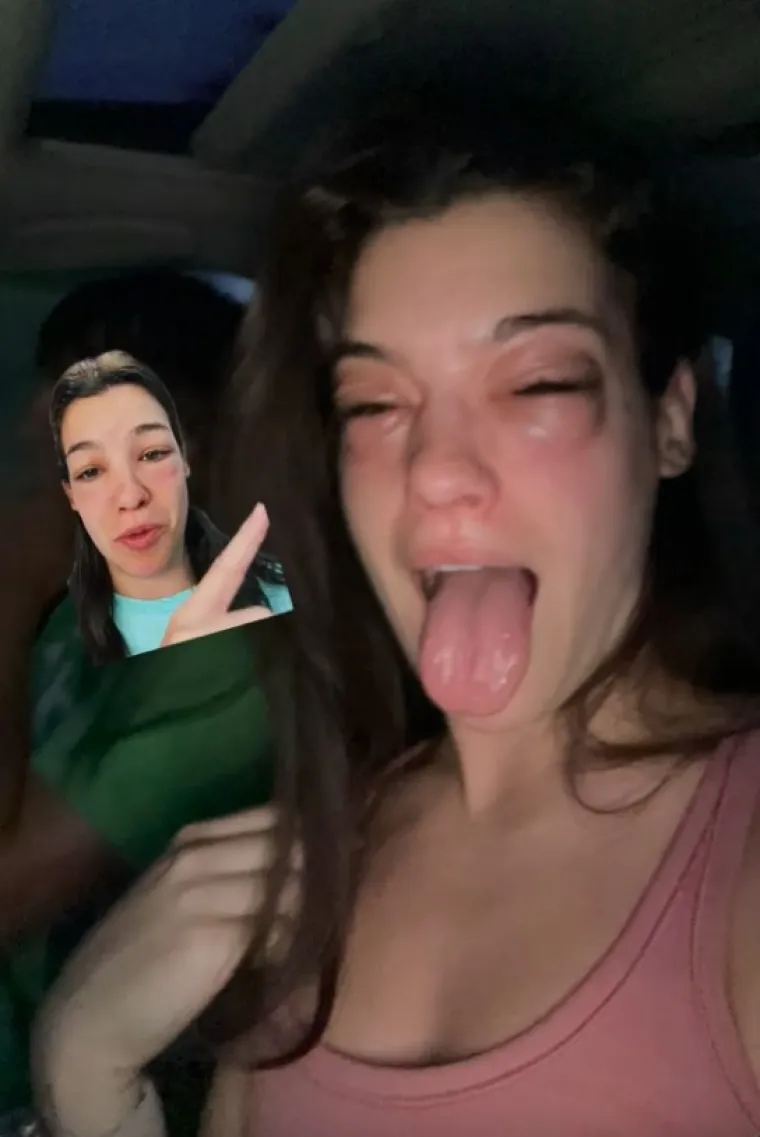 Pojela je komad pizze i tijekom tri naredna sata natekla kao da je glavu gurnula u osinjak