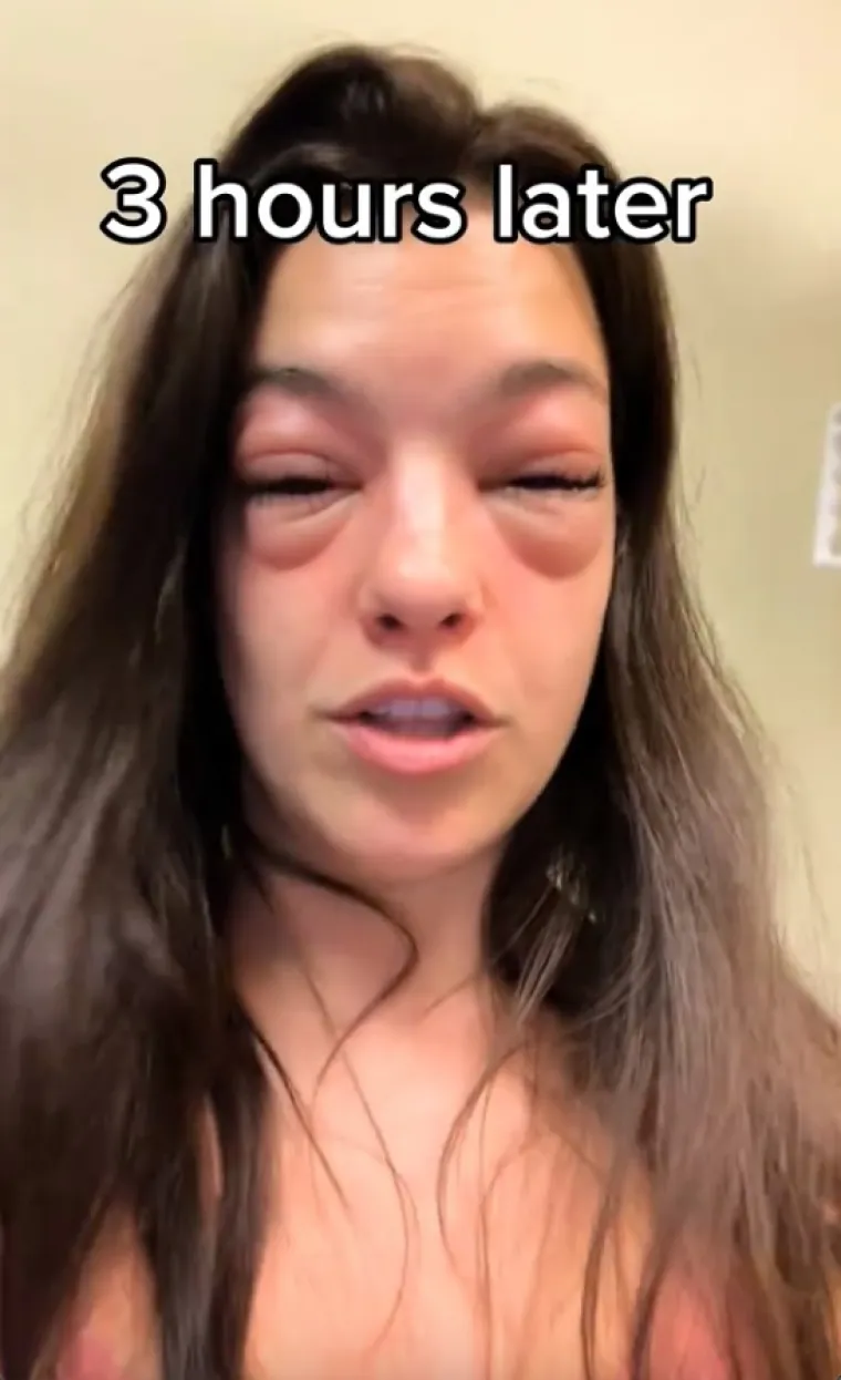 Pojela je komad pizze i tijekom tri naredna sata natekla kao da je glavu gurnula u osinjak