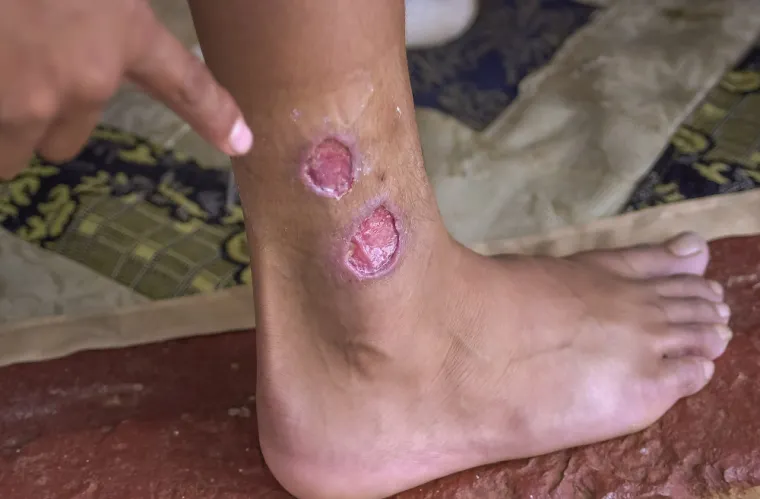 4. Lišmanijazu prenose Phlebotomine vrste pješčanih mušica. Zemlje u kojima je kukac ustanovljen su Španjolska, Italija, Grčka i Portugal. Lišmanijaza je bolest koju možete dobiti od ugriza zaražene pješčane mušice. Česta je u prašumama, pustinjama i urbanim područjima Amerike, Azije, Afrike, a u novijim desetljećima i Europe.