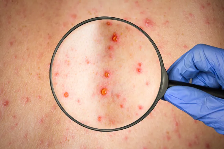 8. Virus zapadnog Nila prenose Culex komarci. Nalazi se u Španjolskoj, Portugalu, Francuskoj, Italiji, Grčkoj, Cipru, Bugarskoj, Rumunjskoj, Srbiji, Hrvatskoj, Mađarskoj i Turskoj. Virus zapadnog Nila prenosi se na ljude preko komaraca Culex koji se hrane zaraženim pticama koje su prirodni izvori bolesti. Obično se infekcija nalazi u Africi, na Bliskom istoku i u dijelovima Azije. Prije nekoliko desetljeća bolest je stigla do Europe, ali tek u novije vrijeme bilježimo porast slučajeva. Tijekom 2023. otkriveno je 713 lokalno stečenih slučajeva virusa Zapadnog Nila u 123 različite regije devet zemalja EU-a, objavio je ECDC. Otprilike jedna od pet osoba razvit će simptome, uključujući glavobolju, bolove u zglobovima i osip, a jedan posto će razviti tešku bolest uključujući dva stanja oticanja mozga koja se nazivaju encefalitis ili meningitis, oba mogu biti fatalna.
