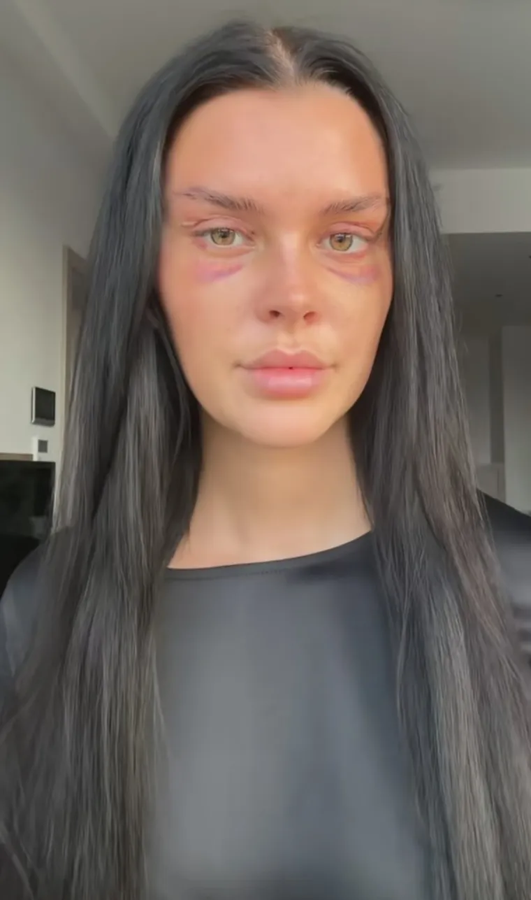 Podvrgnula se tretmanu: Evo kako Nelly Nelnoire izgleda nakon riskantne operacije