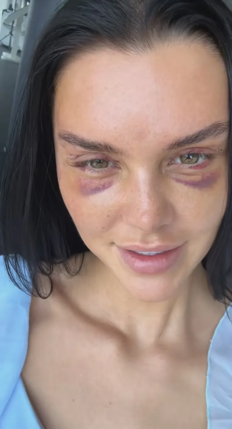 Podvrgnula se tretmanu: Evo kako Nelly Nelnoire izgleda nakon riskantne operacije