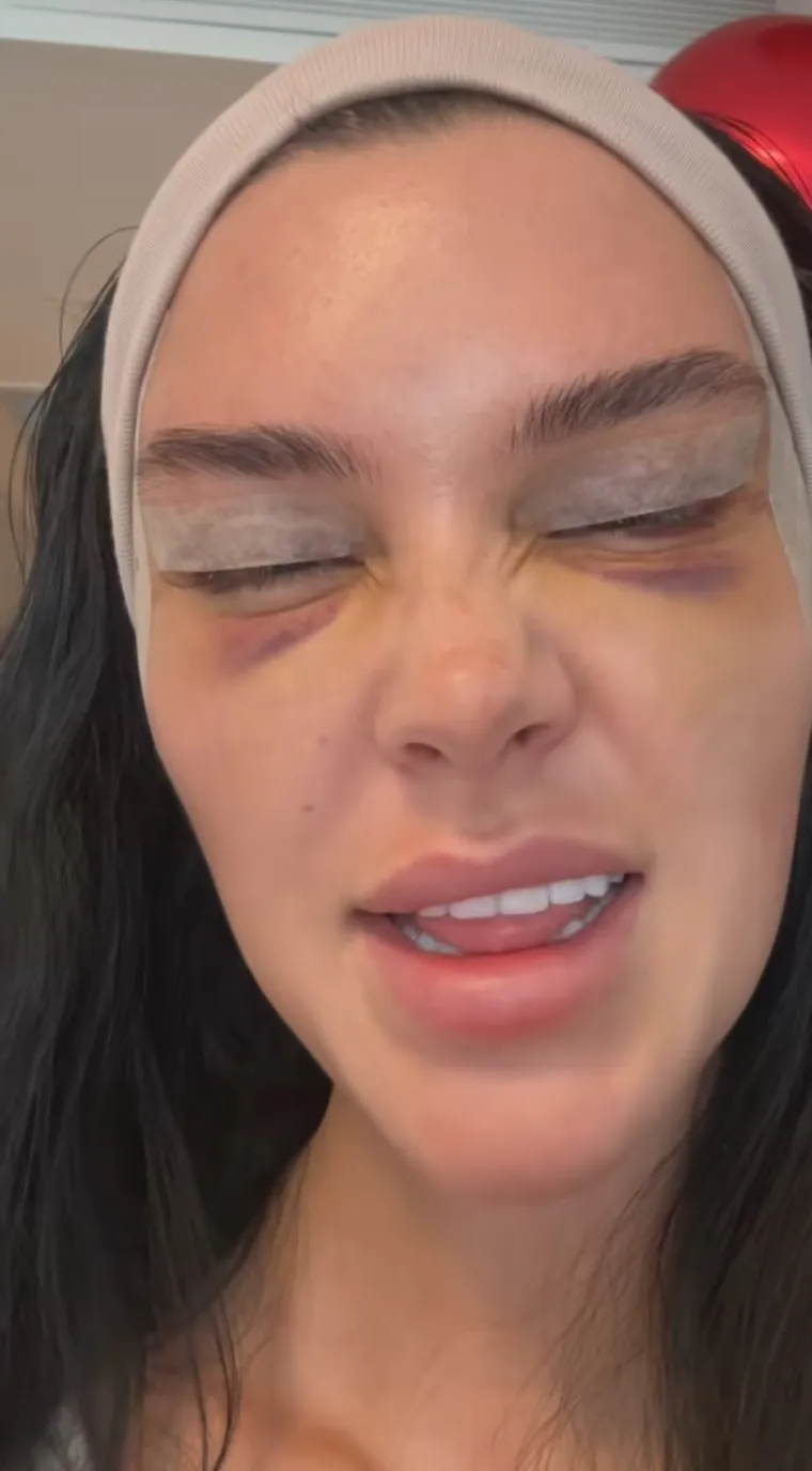 Podvrgnula se tretmanu: Evo kako Nelly Nelnoire izgleda nakon riskantne operacije