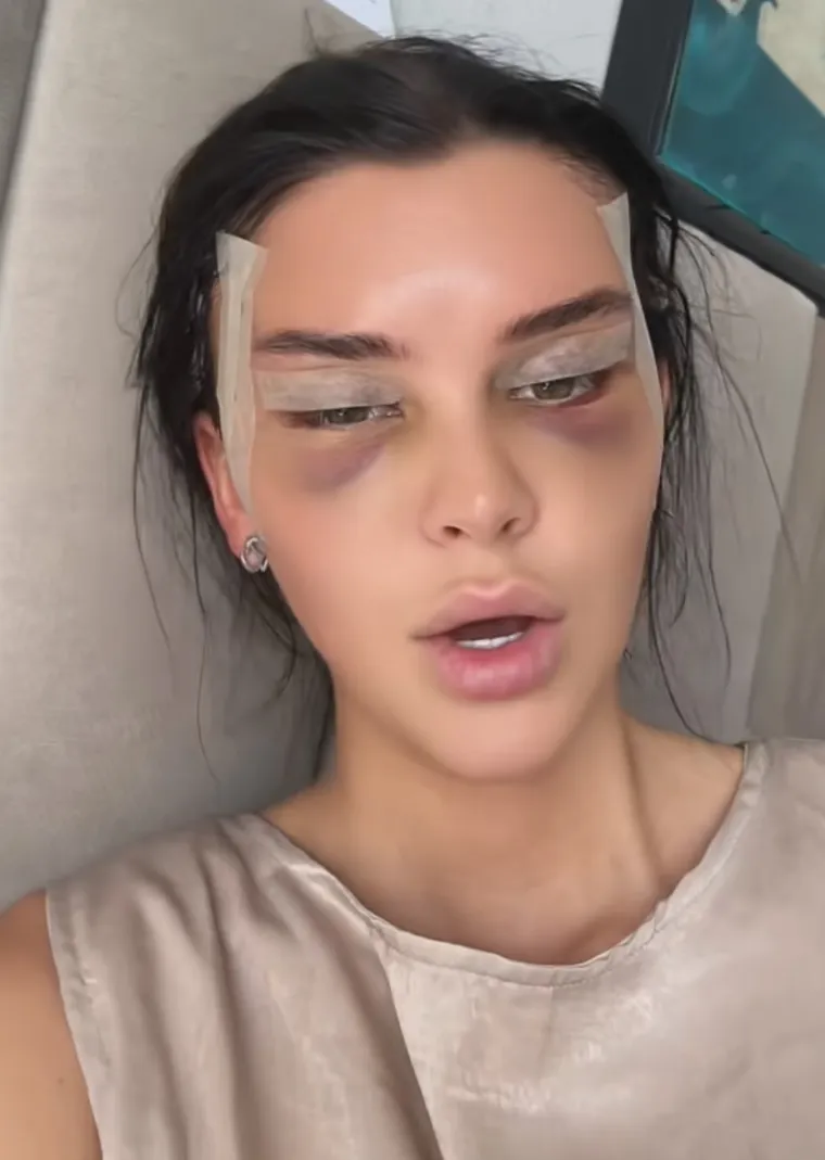 Podvrgnula se tretmanu: Evo kako Nelly Nelnoire izgleda nakon riskantne operacije