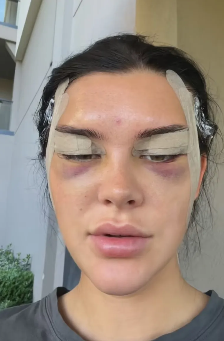 Podvrgnula se tretmanu: Evo kako Nelly Nelnoire izgleda nakon riskantne operacije