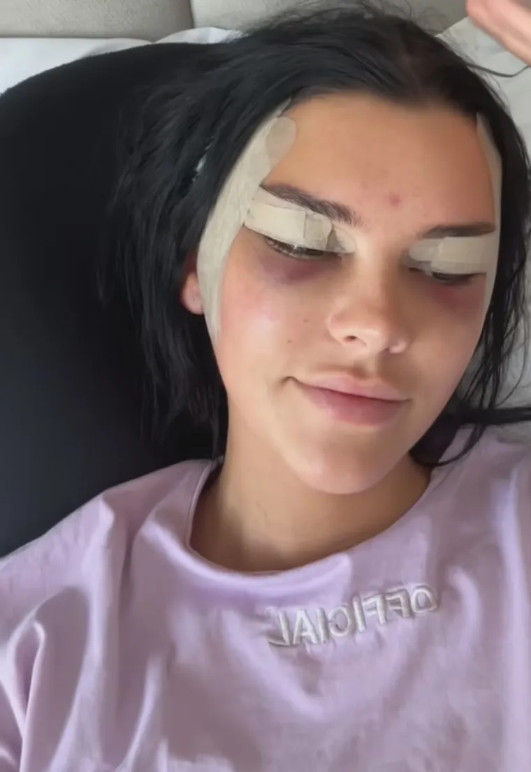 Podvrgnula se tretmanu: Evo kako Nelly Nelnoire izgleda nakon riskantne operacije