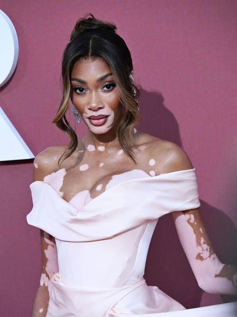 Ovo je Winnie Harlow - manekenka koja boluje od iste bolesti kao Michael Jackson
