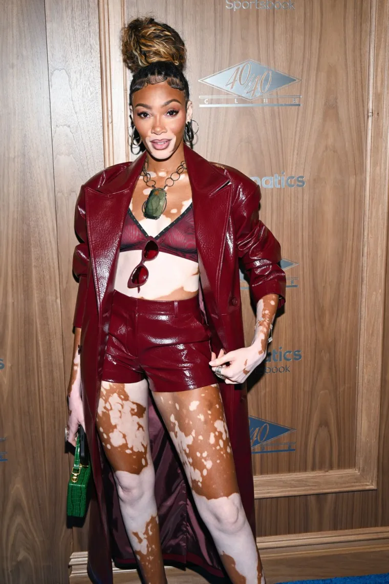 Ovo je Winnie Harlow - manekenka koja boluje od iste bolesti kao Michael Jackson