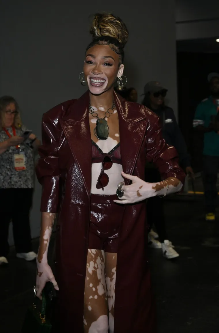 Ovo je Winnie Harlow - manekenka koja boluje od iste bolesti kao Michael Jackson