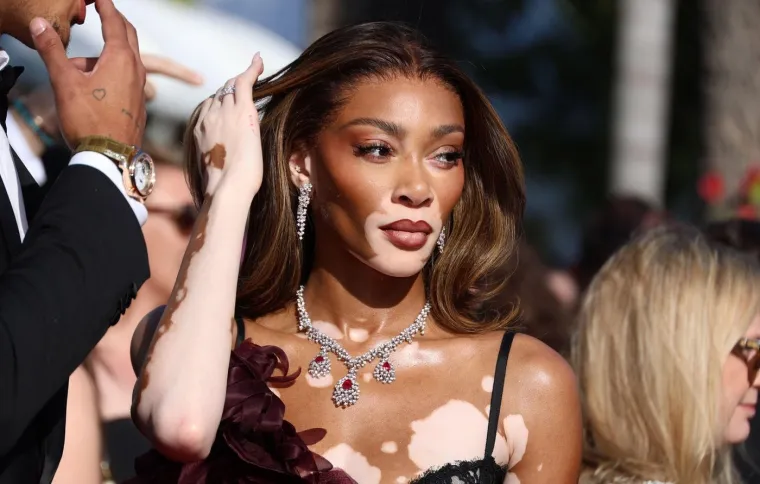 Ovo je Winnie Harlow - manekenka koja boluje od iste bolesti kao Michael Jackson