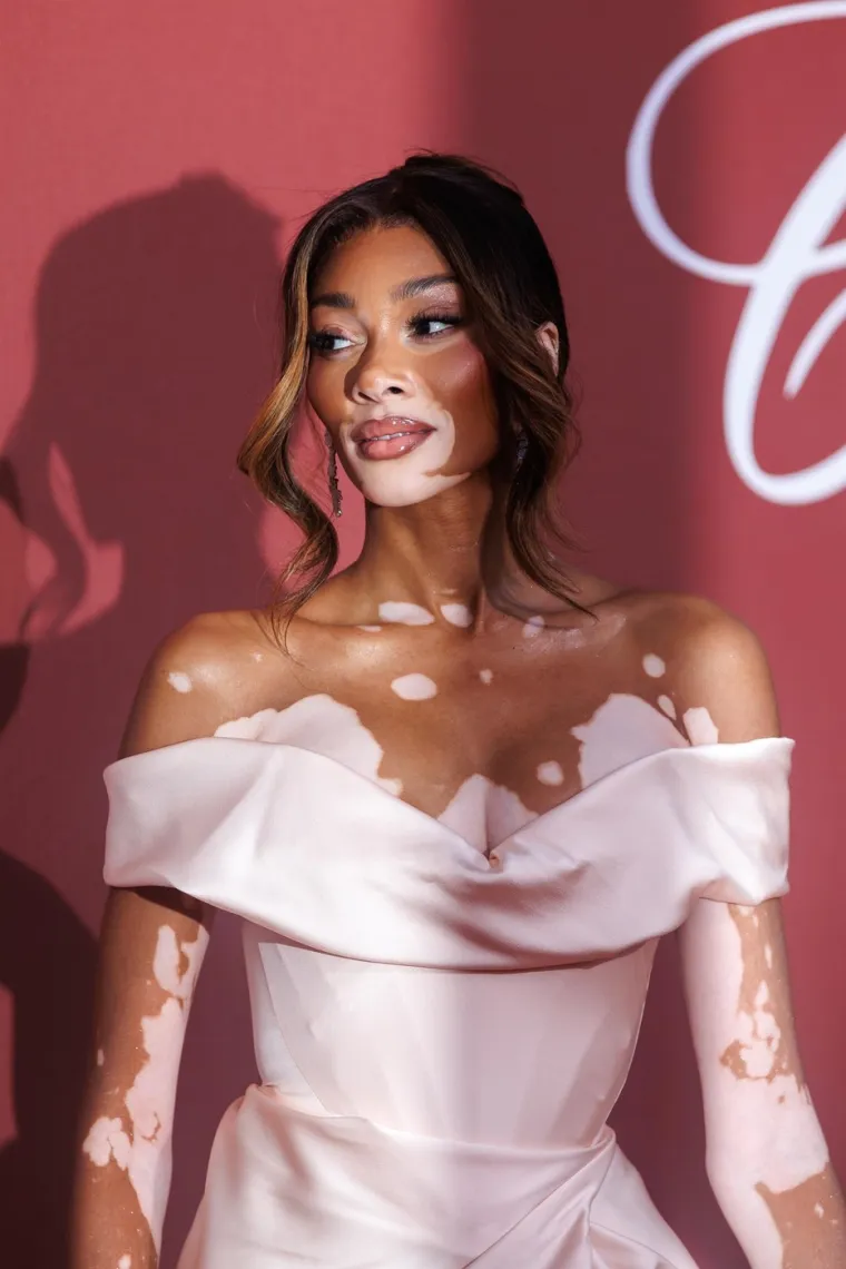 Ovo je Winnie Harlow - manekenka koja boluje od iste bolesti kao Michael Jackson