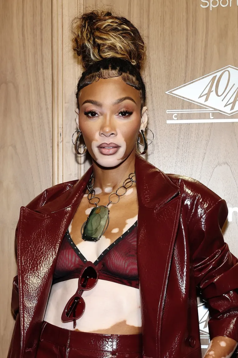 Ovo je Winnie Harlow - manekenka koja boluje od iste bolesti kao Michael Jackson