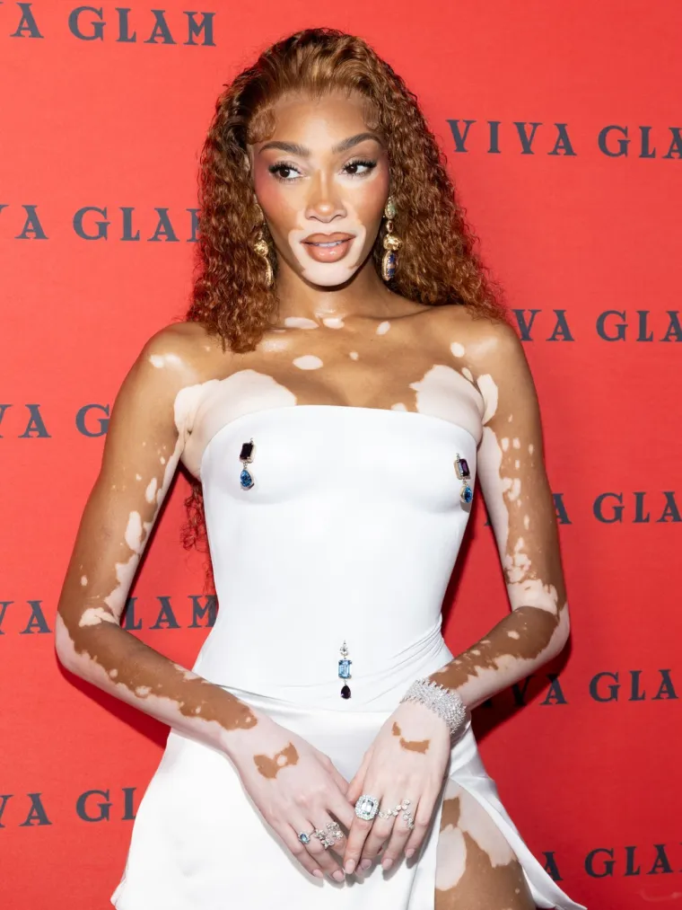 Ovo je Winnie Harlow - manekenka koja boluje od iste bolesti kao Michael Jackson