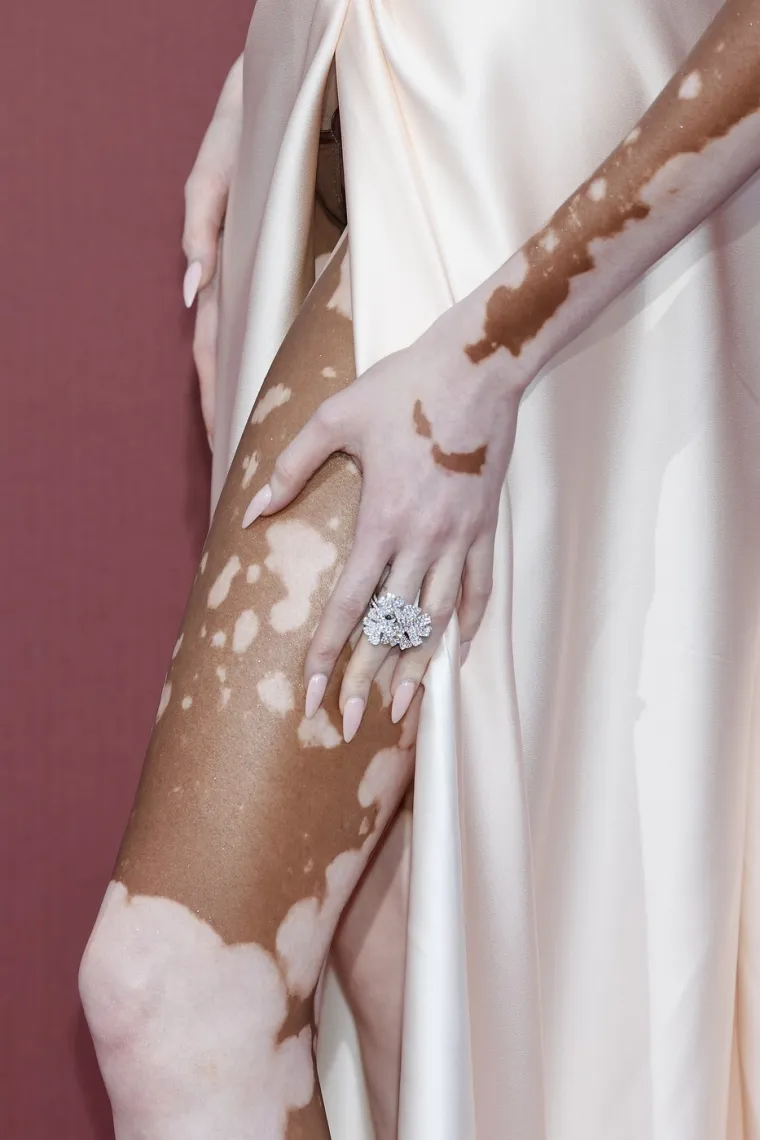 Ovo je Winnie Harlow - manekenka koja boluje od iste bolesti kao Michael Jackson