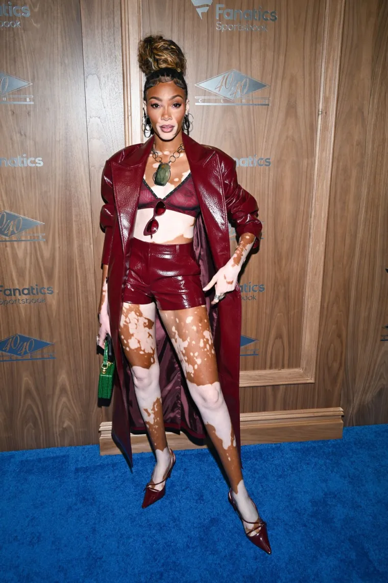 Ovo je Winnie Harlow - manekenka koja boluje od iste bolesti kao Michael Jackson