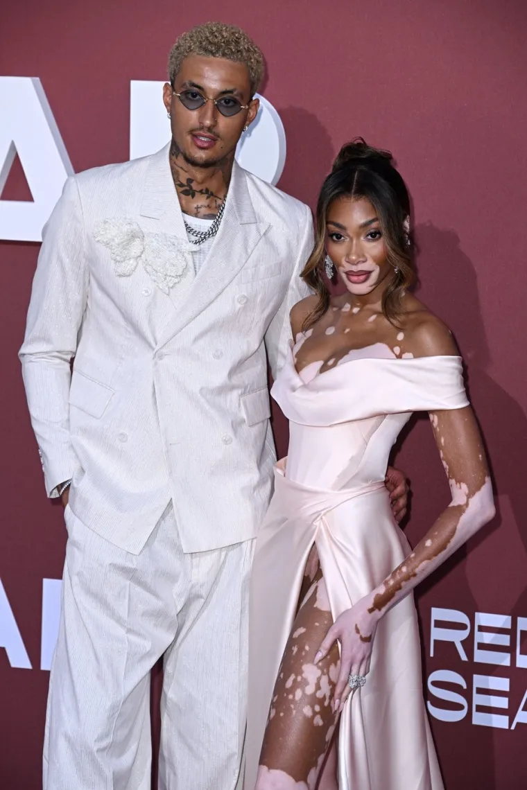 Ovo je Winnie Harlow - manekenka koja boluje od iste bolesti kao Michael Jackson