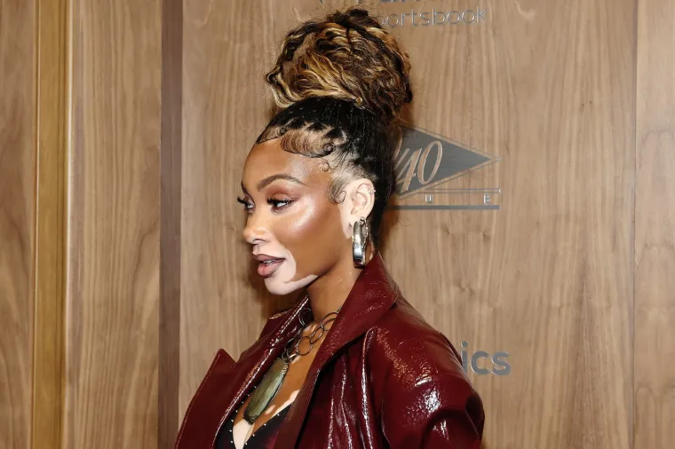 Ovo je Winnie Harlow - manekenka koja boluje od iste bolesti kao Michael Jackson