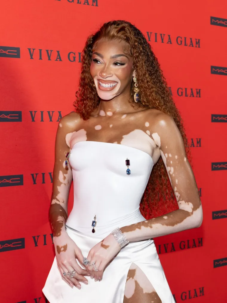 Ovo je Winnie Harlow - manekenka koja boluje od iste bolesti kao Michael Jackson