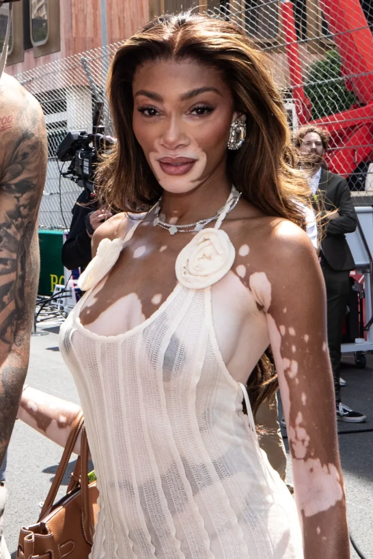 Ovo je Winnie Harlow - manekenka koja boluje od iste bolesti kao Michael Jackson