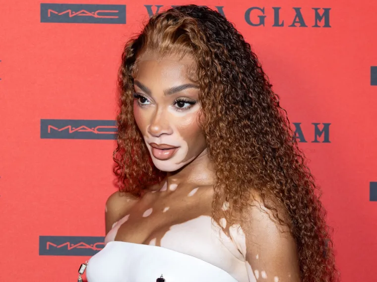 Ovo je Winnie Harlow - manekenka koja boluje od iste bolesti kao Michael Jackson