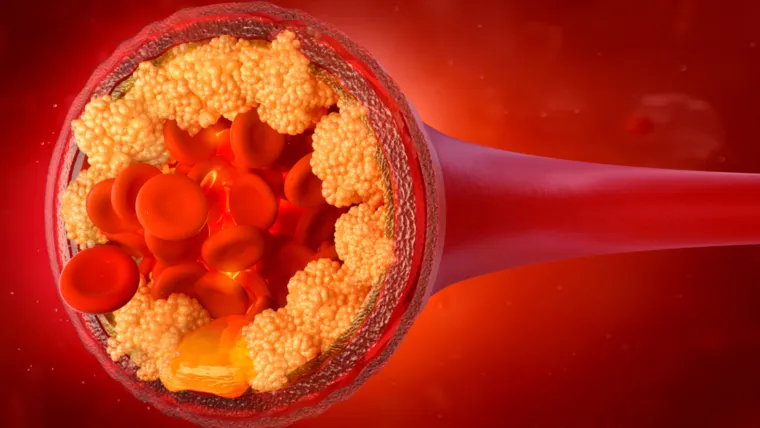 3. Visoki LDL kolesterol: Visoke razine LDL kolesterola, također poznate kao &quot;loš&quot; kolesterol, mogu uzrokovati nakupljanje kolesterola u vašim arterijama.