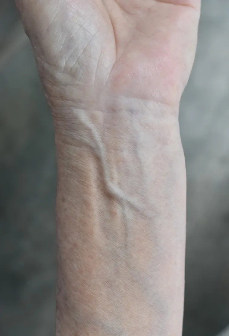 U nekoj literaturi se navodi da je deset posto ljudi rođeno bez ove tetive, a u drugoj se, pak, tvrdi da taj broj iznosi 16 posto. Bilo kako bilo, ljudi počeli hodati na dvije noge prije otprilike 3,2 milijuna godina, pa je potreba za vje&scaron;anjem i ljuljanjem na drveću postala zastarjela.