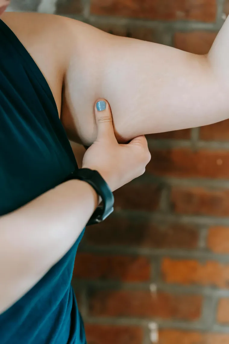 U mnogim slučajevima ljudi imaju nabore od viška kože. Ako takvih nabora nije previše mogu se popuniti s više mišićne mase. No u ekstremnim slučajevima operacija je jedina opcija.