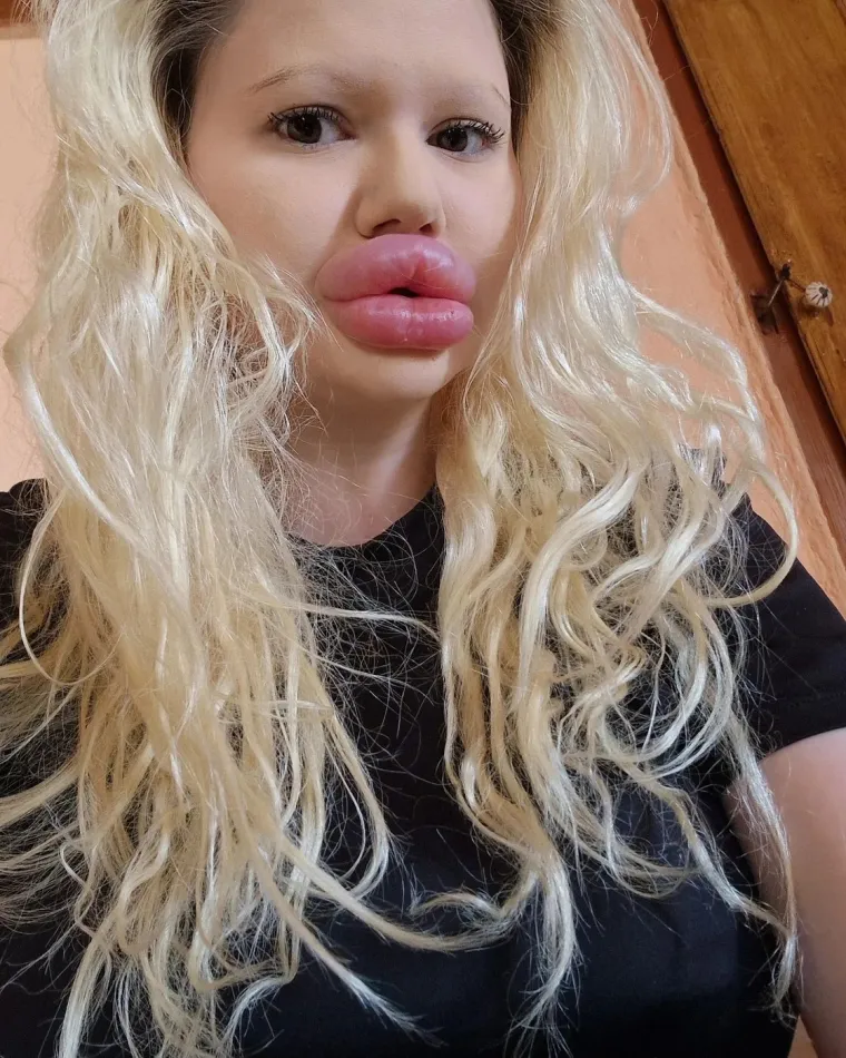 Bugarska Barbie do danas je u sebe ubrizgala više od 30 injekcija punjenih hijaluronskom kiselinom, a portal The Sun prenio je prije nekoliko mjeseci informaciju kako planira ubrizgati filere i s obje strane nosa u želji da ujednači lice i sačuvala mladolik izgled.