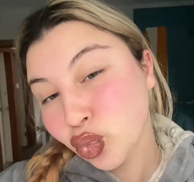 Oteklina se počela smanjivati tek nakon dva dana, ali Tash je odlučila ne izlaziti iz kuće bez maske kako bi sakrila neslavne posljedice zahvata. Iako je ranije bez problema povećala gornju usnu botoksom, priznaje da je trajna šminka potpuno druga priča.