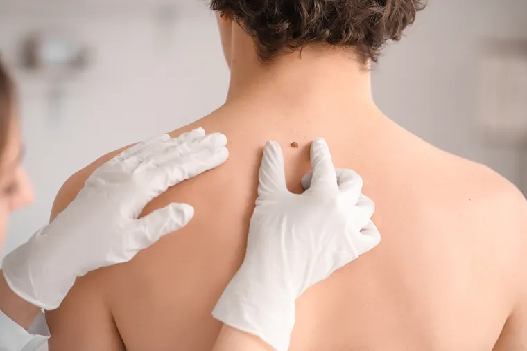 21. Je li moj madež kancerogen? &Scaron;ansa da imate rak kože je velika kada se konzultirate s dr. Googleom. Često ćete pronaći fotografiju ili video s malignim madežem koji izgleda ba&scaron; poput va&scaron;eg. Bolje je otići na pregled kod dermatologa. 