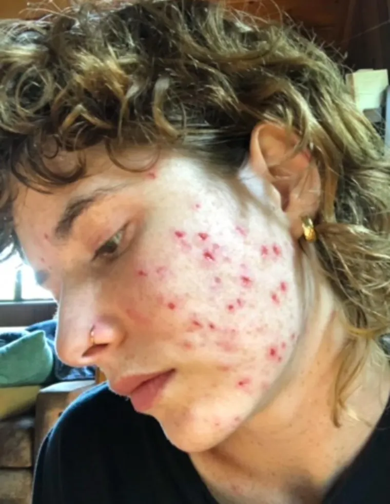 Korisnica Forest_Froggie patila se s mentalnim zdravljem i ekskorijacijom, poremećajem grebanja kože.