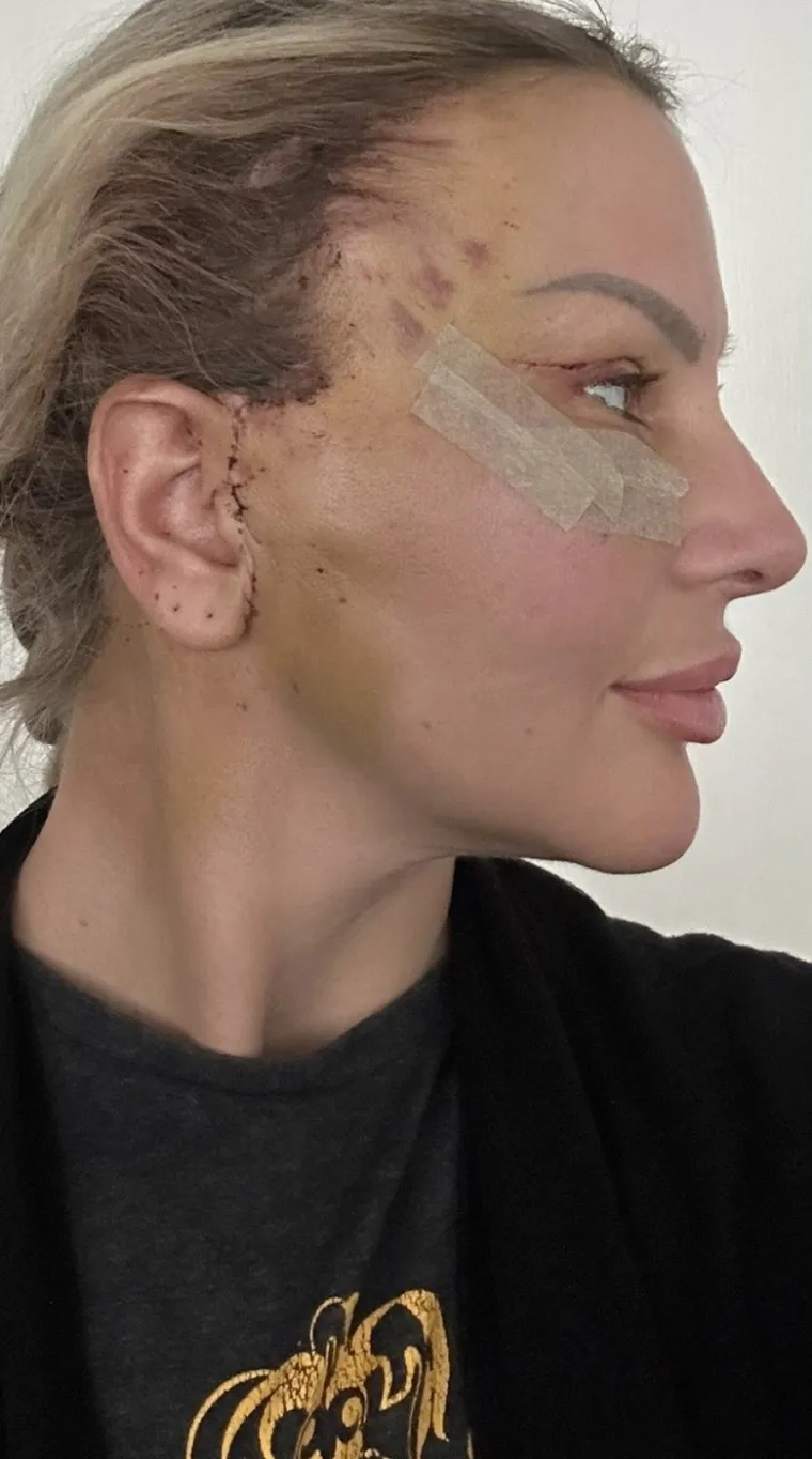 Mnogi ljudi žele ublažiti njegove vidljive znakove, pa lifting lica može biti rje&scaron;enje ako se osjećate samosvjesno zbog opu&scaron;tene kože na licu i vratu. 