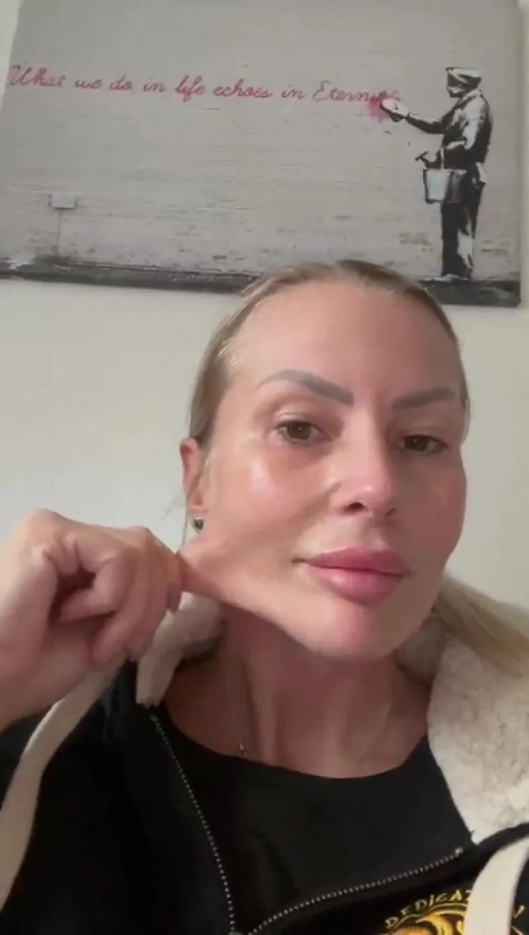 Ako primjećujete duboke bore i nabore, posebno oko nosa i usta (nazolabijalne bore), te imate spu&scaron;tene obraze i gubitak definicije čeljusti, lifting lica može vam pomoći da se osjećate bolje u vlastitoj koži.