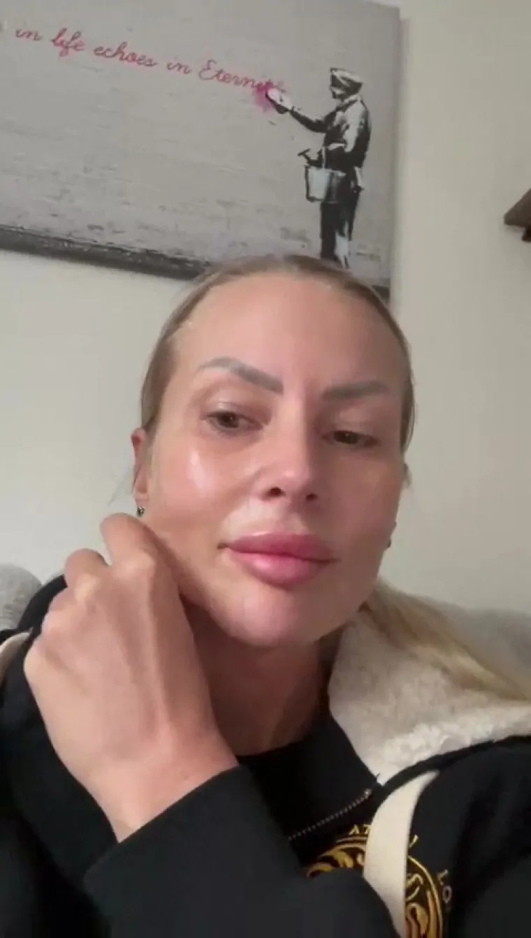 Tradicionalni (SMAS) lifting lica najopsežnija je tehnika i pruža najdramatičnije rezultate. Rezovi se obično postavljaju unutar linije kose, a počinje od sljepoočnica, nastavlja se oko u&scaron;iju te zavr&scaron;ava u vlasi&scaron;tu iza u&scaron;iju.