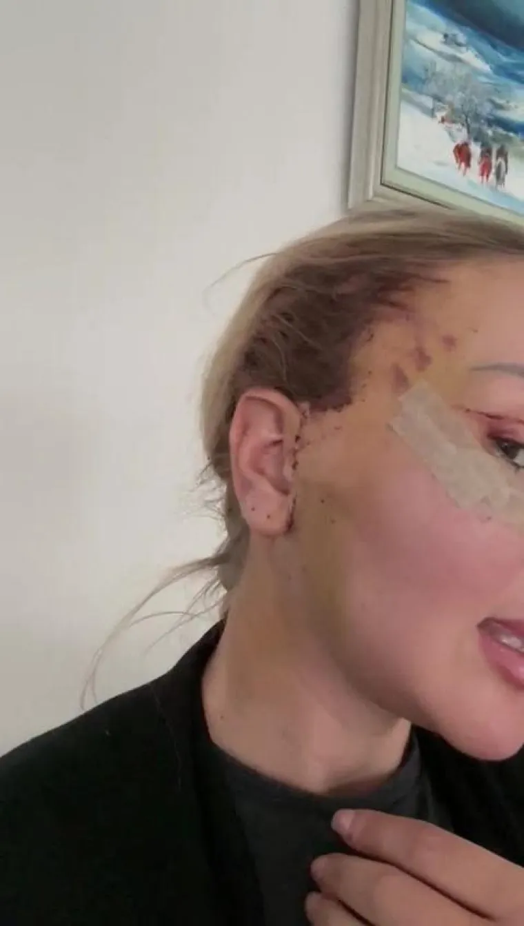 Mini-lifting je manje invazivan zahvat s kraćim rezovima, obično smje&scaron;tenim duž linije kose iznad uha ili u prirodnim naborima oko uha. 