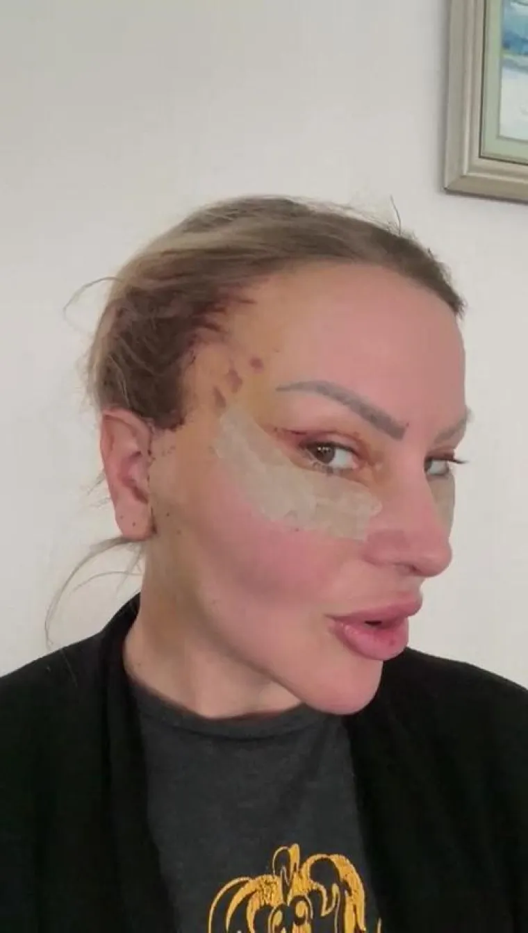 Ova tehnika je prikladna za pacijente s blažim znakovima starenja, prvenstveno u području obraza i čeljusti. Oporavak je obično brži nego kod tradicionalnog liftinga.