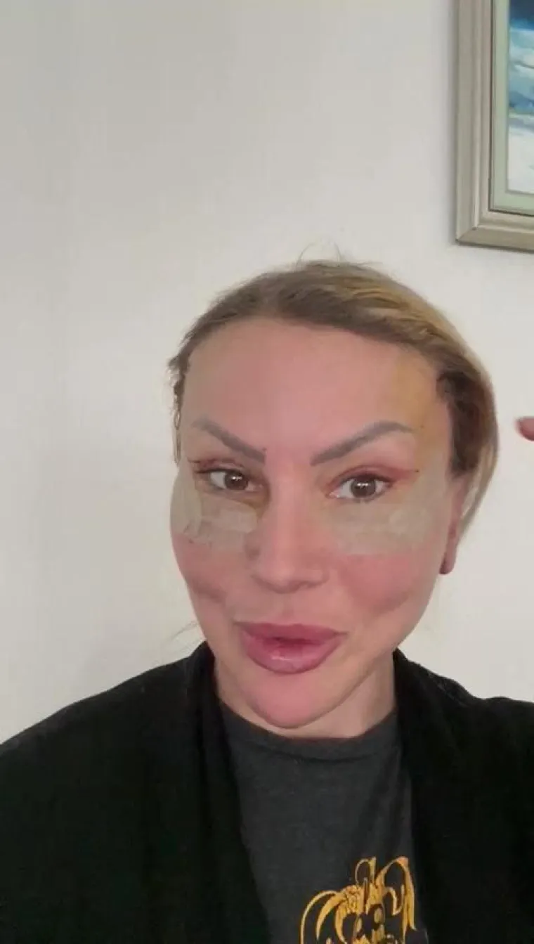 Deep plane lifting lica uključuje repozicioniranje dubljih tkiva lica, uključujući mi&scaron;iće. To omogućuje kirurgu da postigne značajnije podizanje bez pretjeranog zatezanja kože, &scaron;to rezultira prirodnijim izgledom.