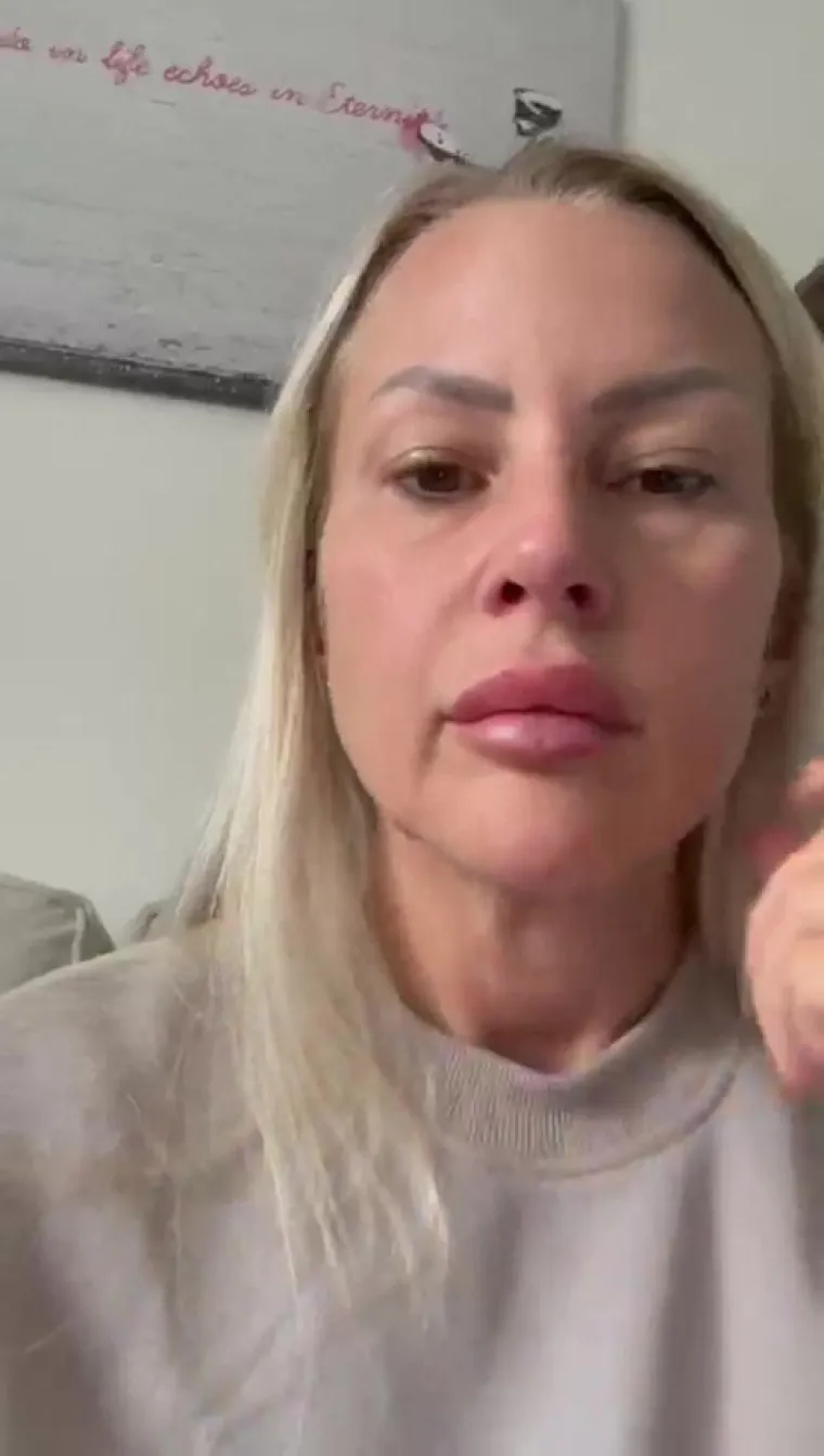 Često uključuje i premje&scaron;tanje masnih jastučića u obrazima, čime stvara puniji i mladenačkiji izgled srednjeg dijela lica.