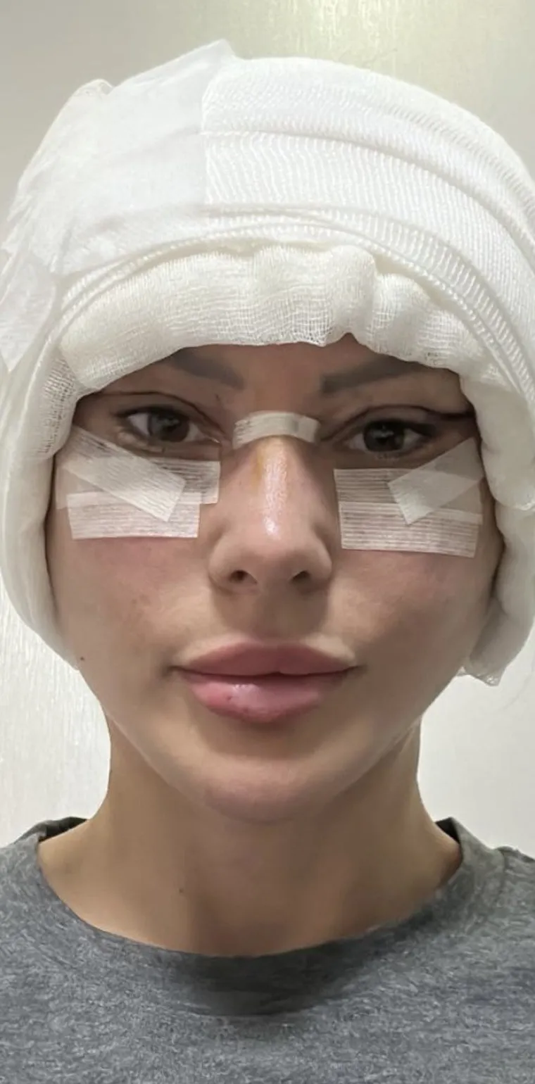 Iako se često izvodi u kombinaciji s liftingom lica, lifting vrata može se izvesti i kao zaseban postupak. Rezovi se obično postavljaju ispod brade i iza u&scaron;iju. Ovaj postupak zateže opu&scaron;tenu kožu vrata i uklanja vi&scaron;ak masnog tkiva.