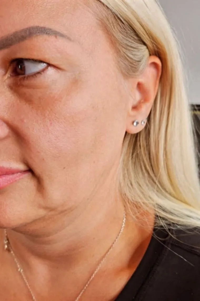 Oporavak nakon liftinga lica ovisi o opsegu zahvata. Nakon tradicionalnog liftinga, uobičajeno je očekivati oticanje, modrice i nelagodu, koji se mogu ublažiti lijekovima protiv bolova.