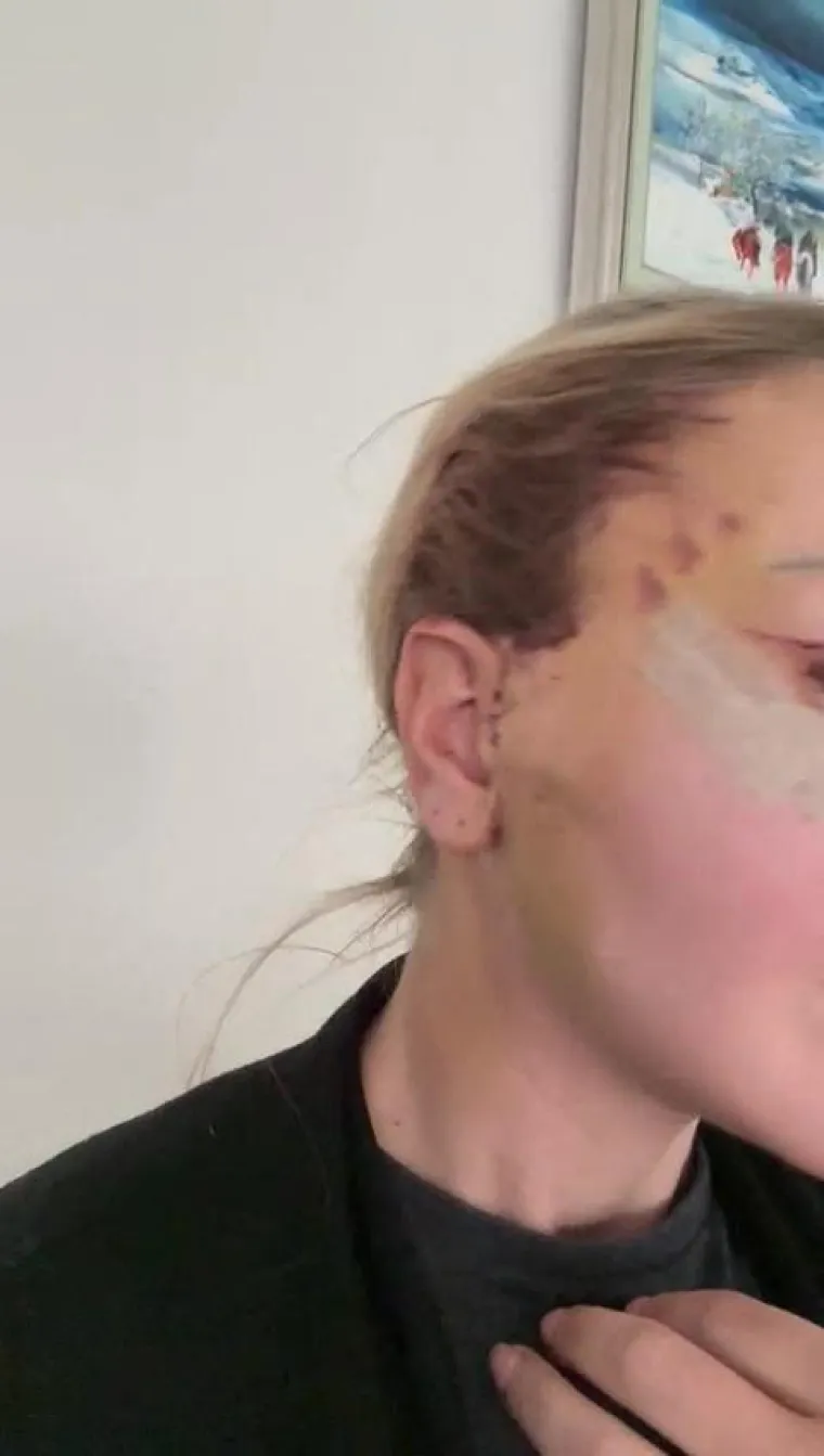 Kao i svaki kirur&scaron;ki zahvat, lifting lica nosi određene rizike: krvarenje i hematom (nakupljanje krvi ispod kože), infekcija, ožiljci (iako su obično dobro skriveni unutar linije kose i prirodnih nabora), o&scaron;tećenje živaca (&scaron;to može uzrokovati privremenu ili trajnu utrnulost ili slabost mi&scaron;ića lica), gubitak kose oko mjesta rezova (obično privremen), asimetrija lica te reakcija na anesteziju.