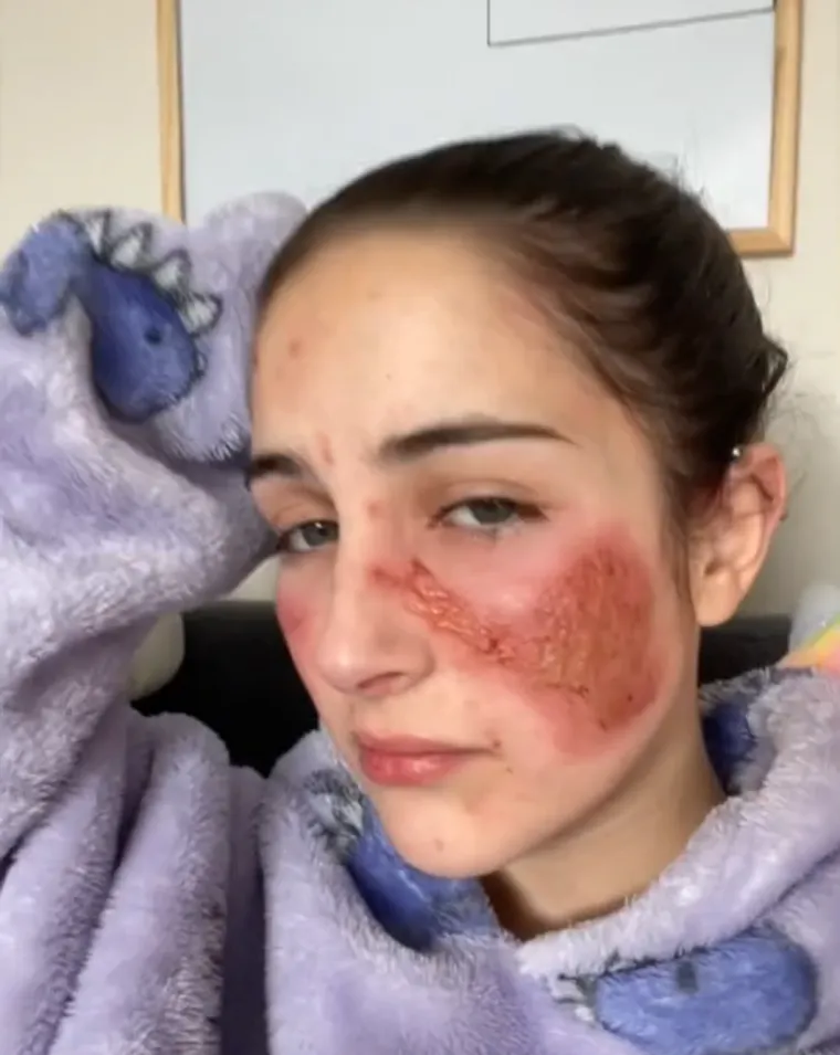 Trpi strašne bolove, a nitko ne zna zašto: 'Bilo da se smijem ili plačem, moja koža gori'