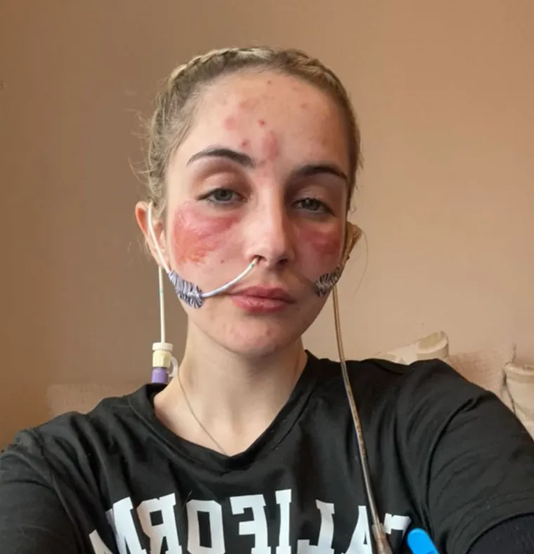 Trpi strašne bolove, a nitko ne zna zašto: 'Bilo da se smijem ili plačem, moja koža gori'