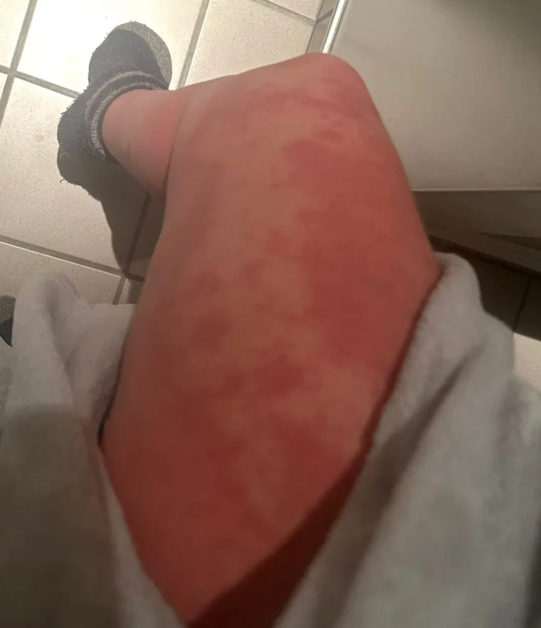 Prestala koristiti kremu i doživjela noćnu moru: 'Nisam znala za ove užasne simptome'