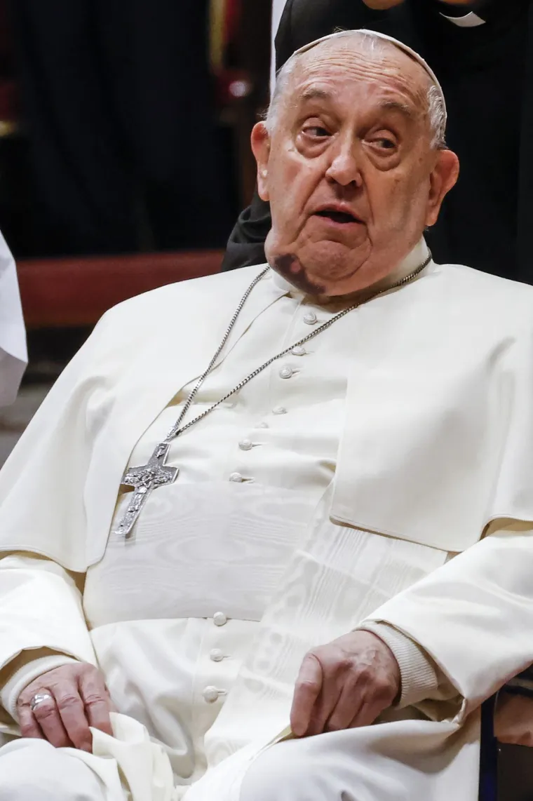 Pao dok je ustajao iz kreveta? Papa Franjo vodio misu za kardinale s licem punim modrica